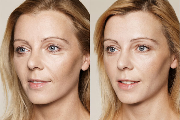 What are Skin Boosters? | Panacea Health and Beauty Clinic