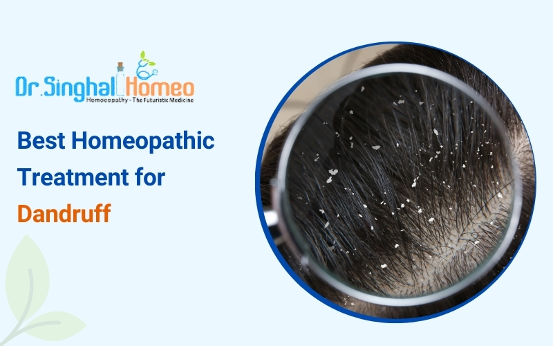Homeopathic Medicine and Treatment for Dandruff: A Comprehensive Guide – health