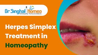 Homeopathic Treatment for Herpes Simplex at Dr. Singhal Homeo || होम्योपैथी में हर्पीस का उपचार