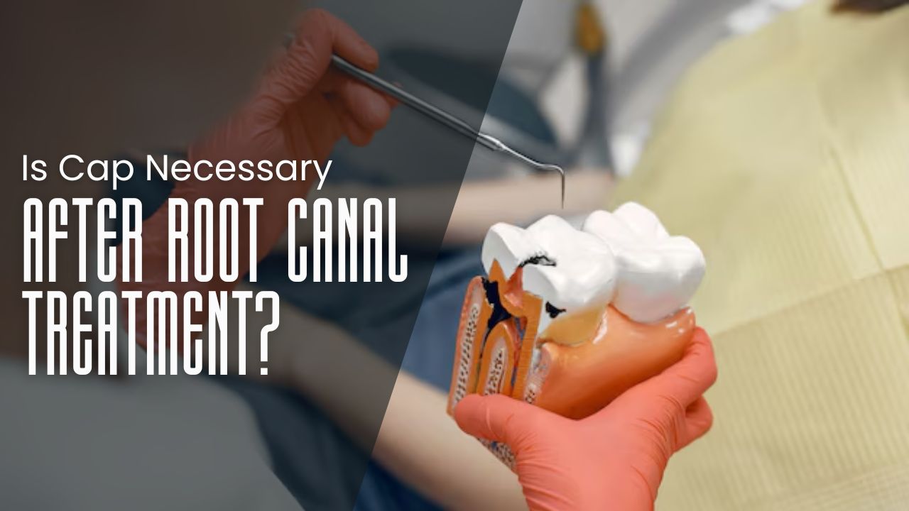 Is Cap Necessary After Root Canal Treatment? - Full Guide