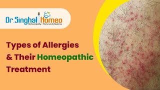होम्योपैथी में एलर्जी का उपचार | Allergy Treatment in Homeopathy