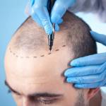Hair Transplant in Riyadh